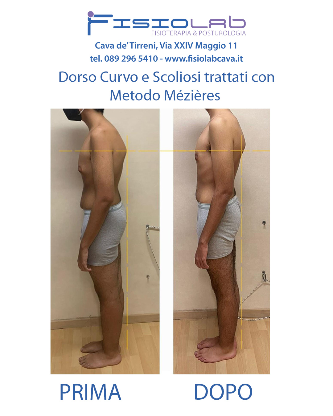 Dorso Curvo trattato con Metodo Mézières